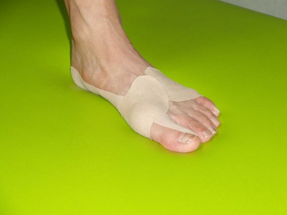 足底腱膜炎のテーピング画像