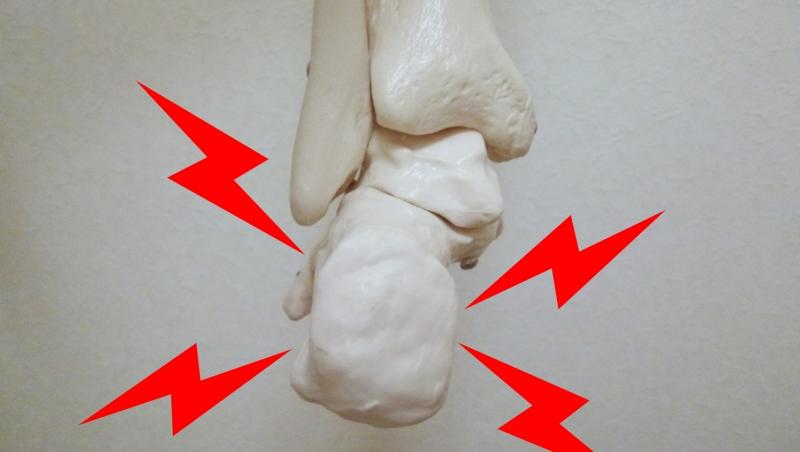 アキレス腱の痛みの模型